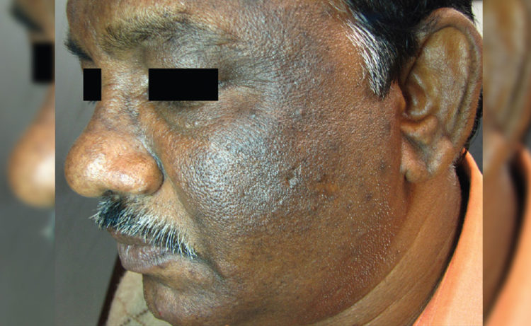 Acanthosis Nigricans- a skin condition prevalent in Vizag