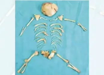 Fetus’ skeleton found inside woman after abortion in Visakhapatnam