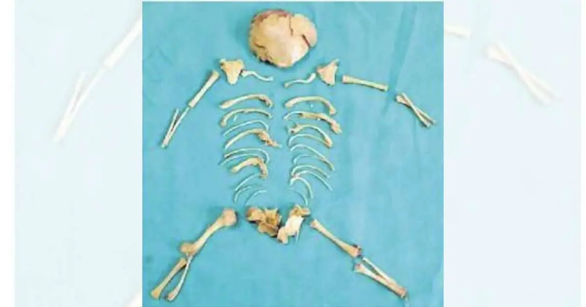 Fetus' skeleton found inside woman after abortion in Visakhapatnam